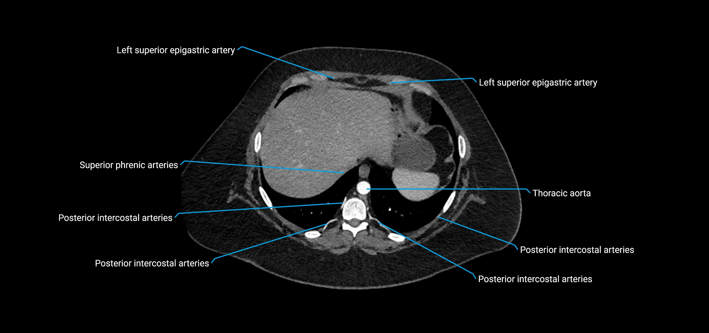 CTA abdomen axial cross sectional anatomy labelled image_21 (2).webp